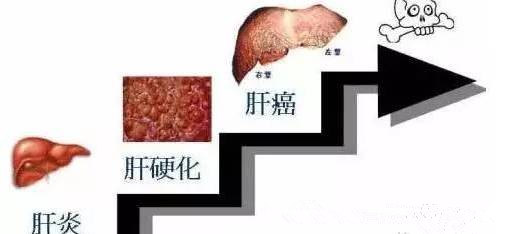 肝病危害催人急,河南省郑州医药科学研究院附属医院专家团巡诊受青睐
