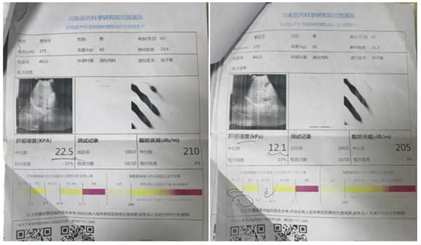 肝不硬了!患者临床应用专利软肝术 成功逆转肝硬化
