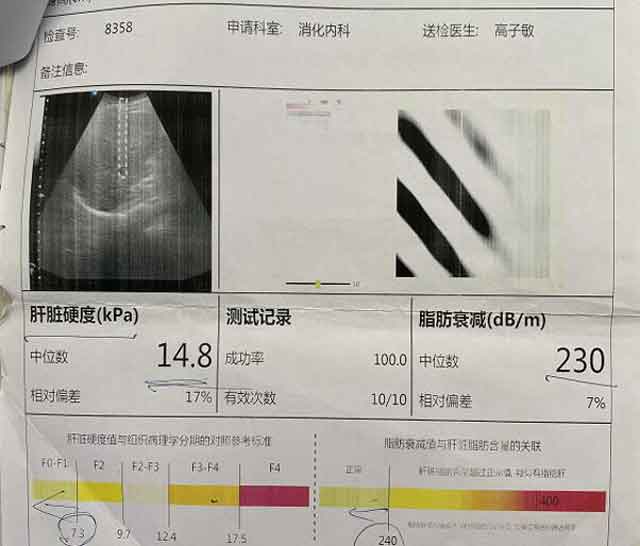 郑州有哪家医院治疗肝硬化比较好