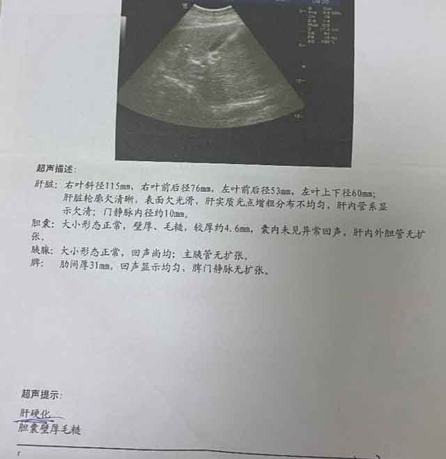 郑州有哪家医院治疗肝硬化比较好
