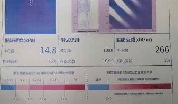 郑州哪家医院治疗肝硬化好点